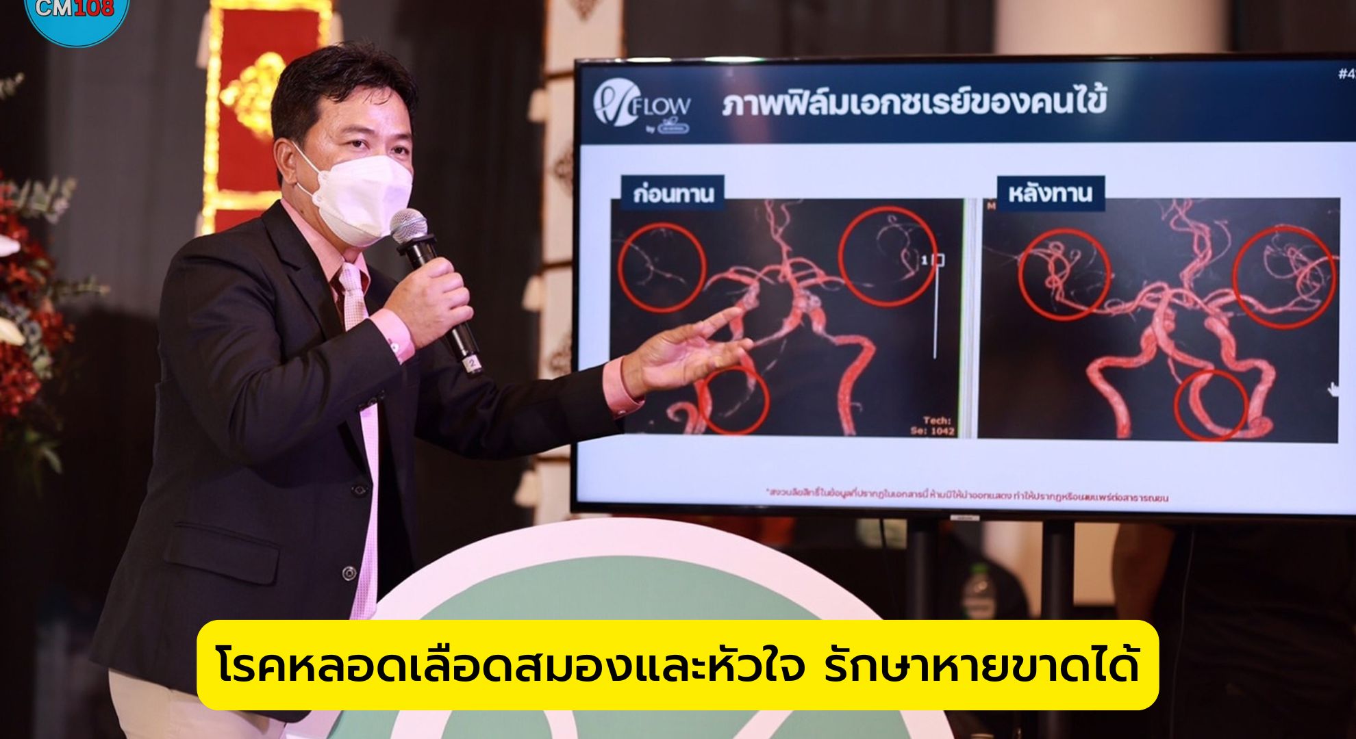 โรคหลอดเลือดสมองและหัวใจ รักษาหายขาดได้