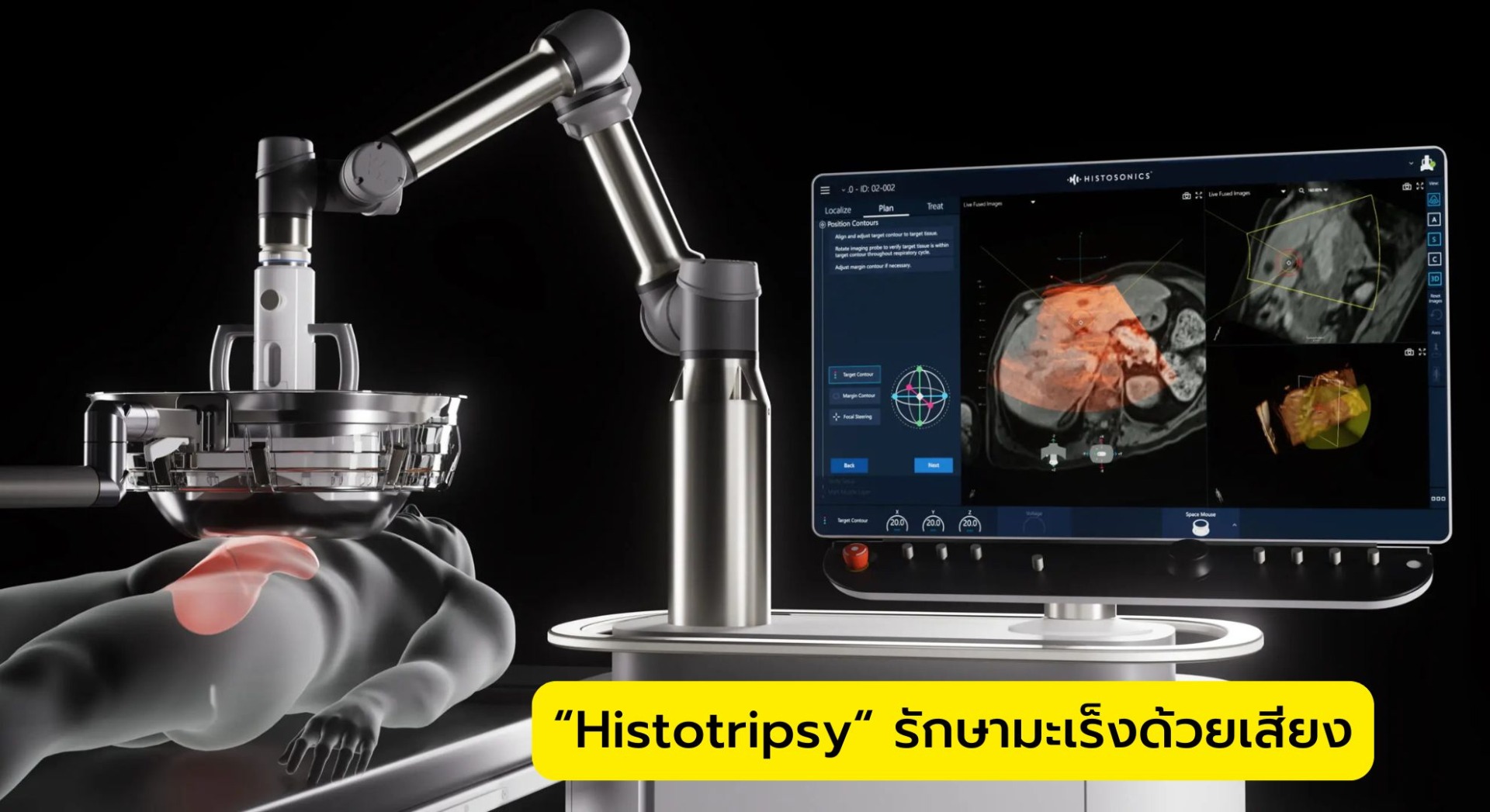 “Histotripsy“ คลื่นเสียงรักษามะเร็ง