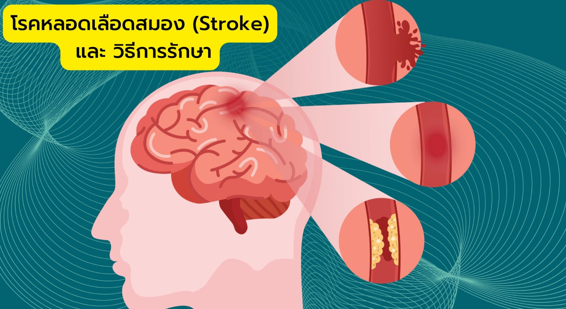 โรคหลอดเลือดสมอง (Stroke) และ วิธีการรักษา