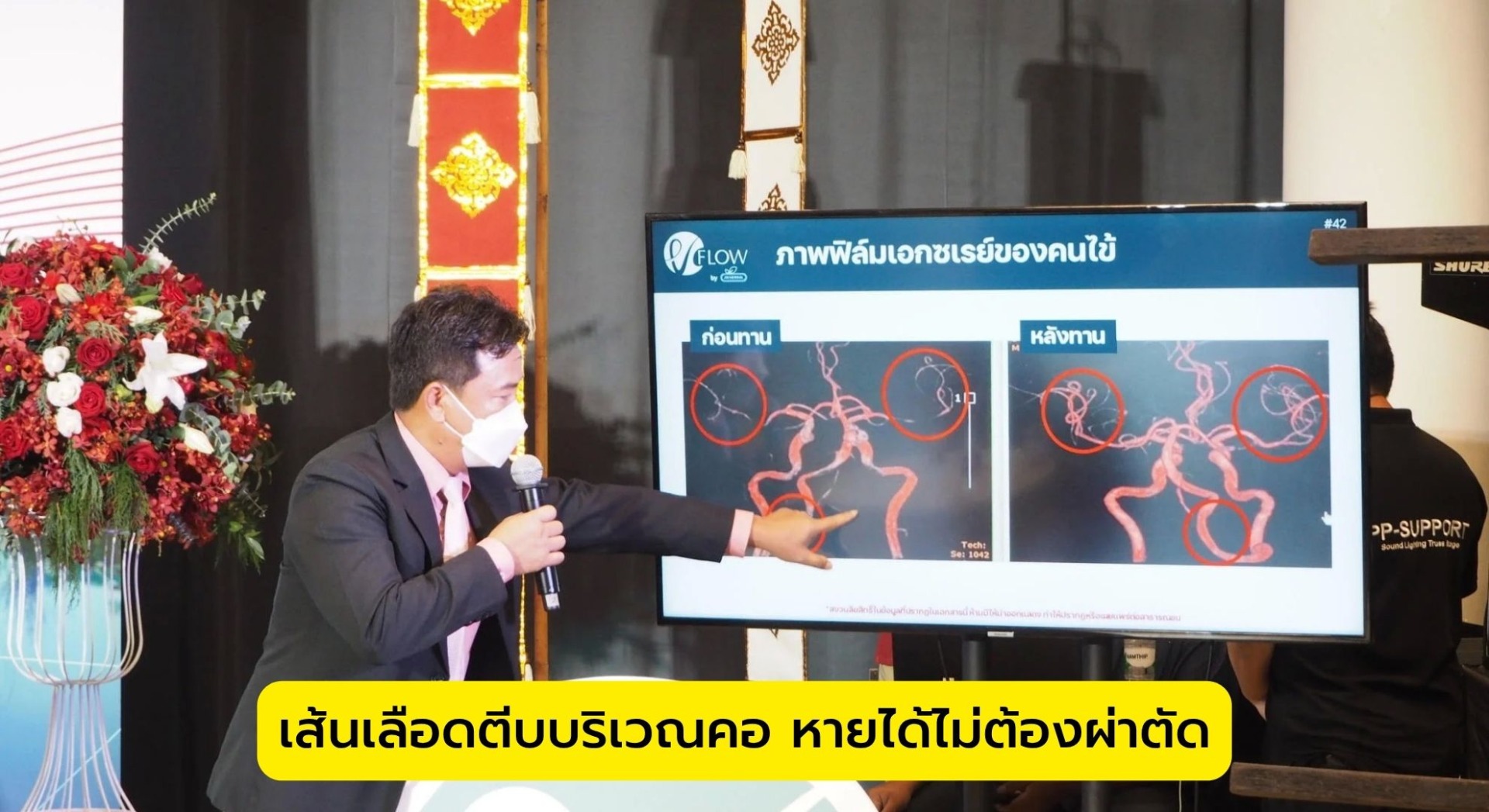 เส้นเลือดตีบบริเวณคอ หายได้ไม่ต้องผ่าตัด