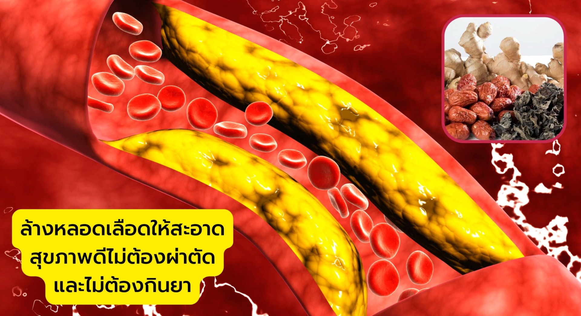 ล้างหลอดเลือดให้สะอาด สุขภาพดีไม่ต้องผ่าตัดและไม่ต้องกินยา